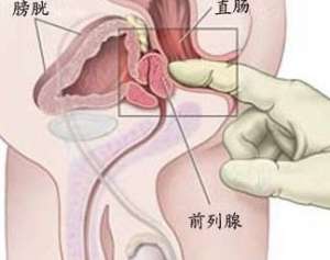 慢性前列腺炎的治疗的几种方法